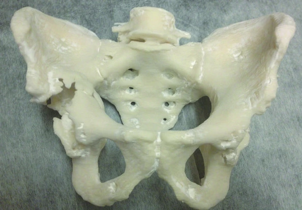 3D printed model of the first patients pelvis