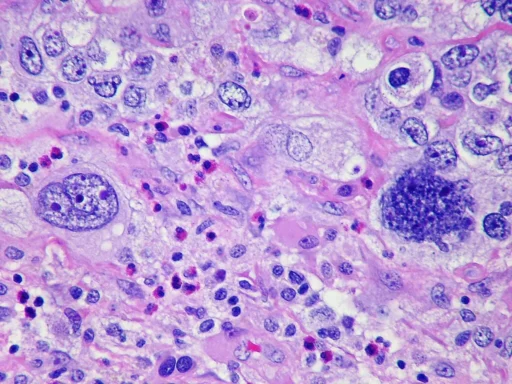 Metastatic poorly differentiated pulmonary adenocarcinoma