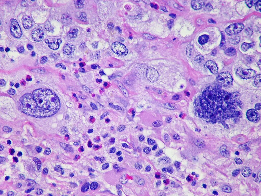 Metastatic poorly differentiated pulmonary adenocarcinoma