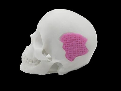 This 3D-printable bio-active glass (shown in pink) could one day be used as a bone substitute.